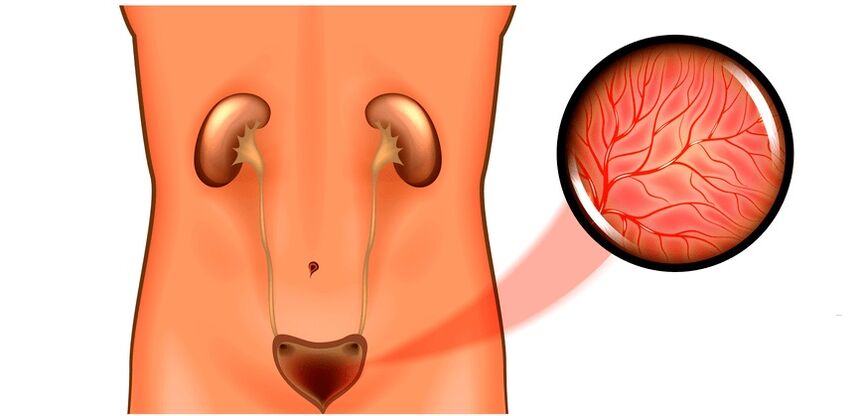 Cistite em sintomas de homens e tratamento