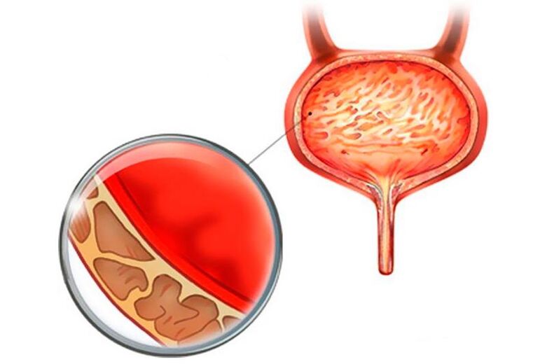 Inflamação da membrana mucosa da bexiga com cistite